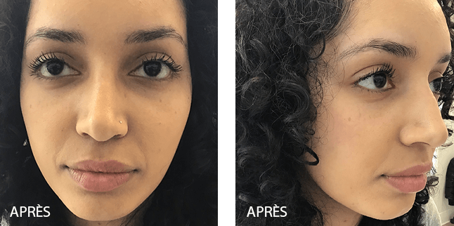 Rajeunissement du visage 2 - Avant/Après