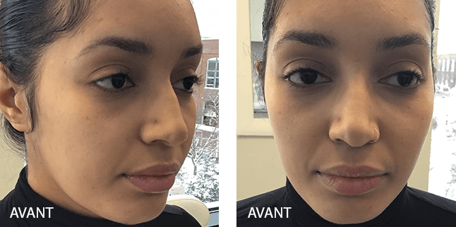 Rajeunissement du visage - Avant/Après